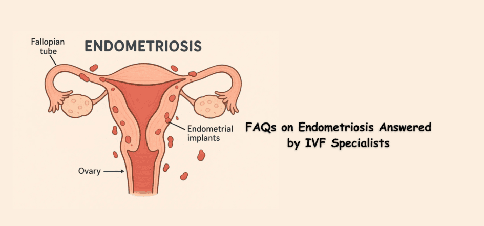 FAQs on Endometriosis Answered by IVF Specialists